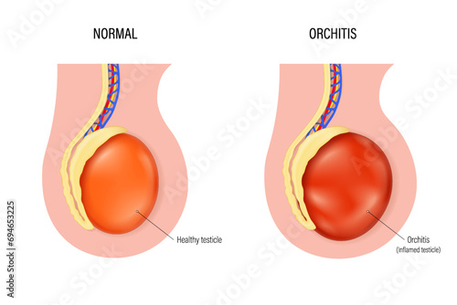 Orchitis vector. Comparison of normal testicle and orchitis. Testicular disease. Male reproductive system. photo