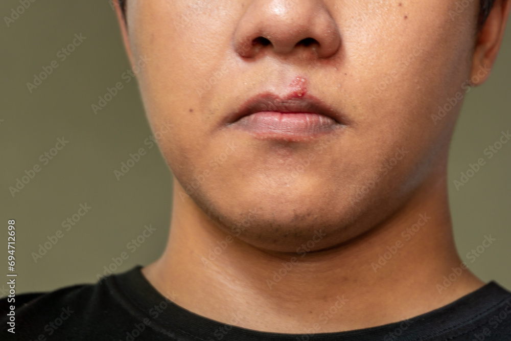 Herpes virus and infection treatment. Men lips affected by herpes blisters Herpes virus and infection treatment. Men lips affected by herpes blisters