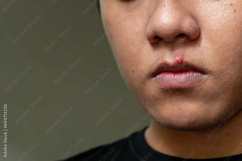 Fototapeta premium Herpes virus and infection treatment. Men lips affected by herpes blisters