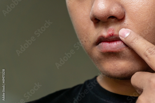 Herpes virus and infection treatment. Men lips affected  by herpes blisters photo