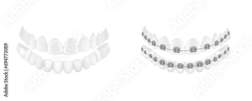 3D Teeth With And Without Orthodontic Braces