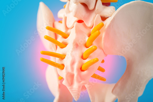 Model of the human spine, section of the inflamed coccyx with nerves on a blue background. Pinched nerve due to problems with the spine. Spondylolisthesis and spinal stenosis, photo