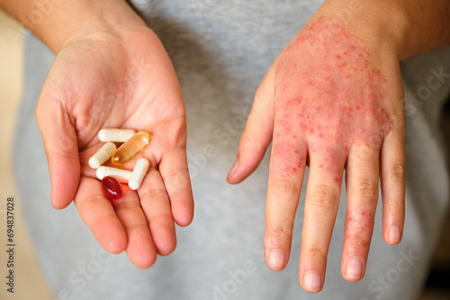 Unrecognizable woman with supplements or pills for treatment of eczema on hand, atopic dermatitis.
