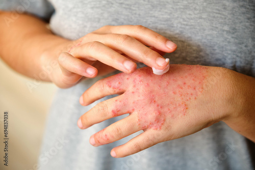 Unrecognizable woman applying ointment or moisturizing cream in the treatment of eczema on hand, atopic dermatitis. photo