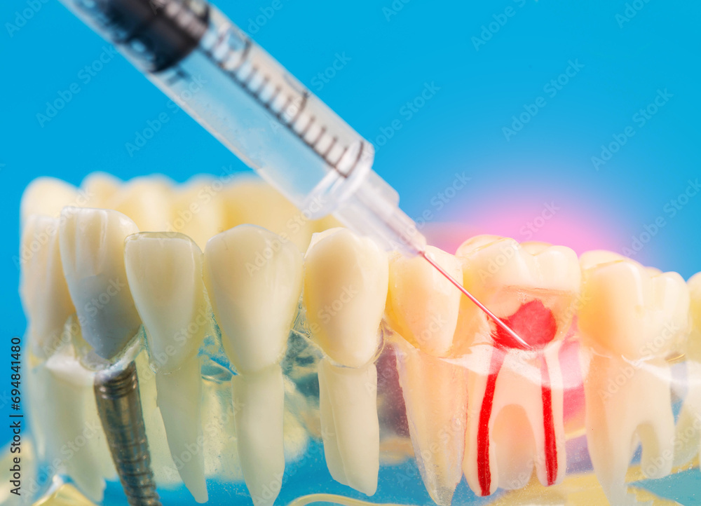Teeth Remove Injection A syringe with an anesthetic anesthetic drug makes an injection into an ...