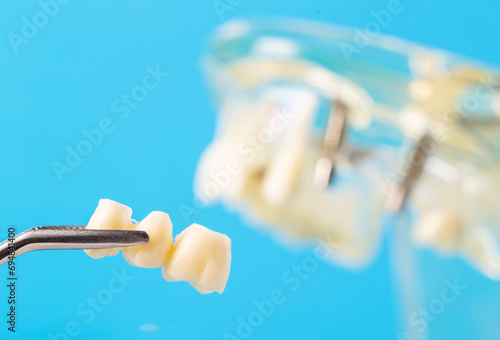 Dental bridge in tweezers against the background of a medical model of the dental jaw, close-up. Dental prosthetics in orthodontics and dentistry. Modern technology. Copy space for text