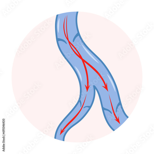 Varicose veins. Blue blood vessel visible through the skin. Vascular disease diagnostic and treatment. Venous insufficiency medical