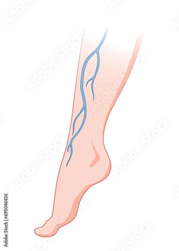 Varicose veins. Blue blood vessel visible through the skin, abnormally swollen leg. Vascular disease diagnostic and treatment. Venous insufficiency medical disease