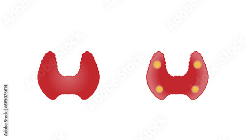 	
Thyroid and parathyroid gland. Anatomy anterior and posterior view of thyroid gland. hypothyroidism vs hyperthyroidism. Vector illustration isolated on white background.