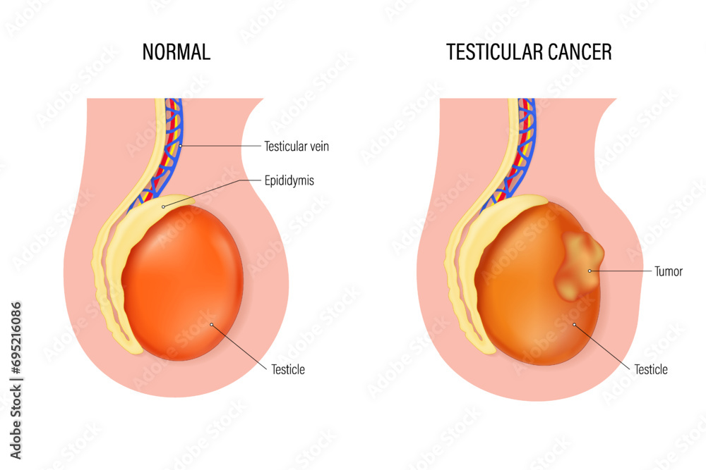 Testicular cancer vector. Comparison of normal testicle and testicular cancer. Testicular disease. Male reproductive system. - obrazy, fototapety, plakaty 