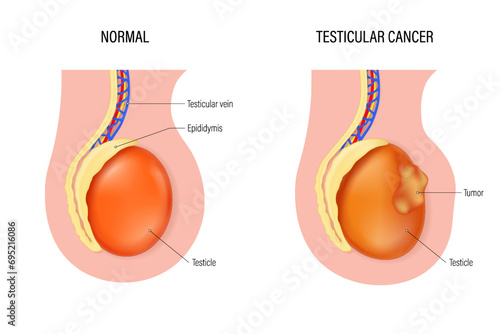Testicular cancer vector. Comparison of normal testicle and testicular cancer. Testicular disease. Male reproductive system. photo