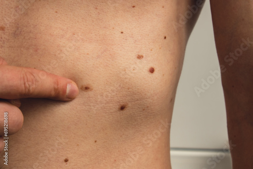 Unrecognizable man showing his birthmarks on skin Close up detail of the bare skin Sun Exposure effect on skin. Health Effects of UV Radiation Male with birthmarks Pigmentation and lot of birthmarks photo
