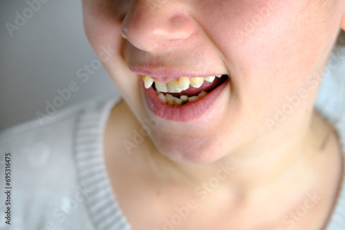 close-up of Curved teeth of young woman before installing braces, girl with an open mouth, concept dentistry, dental treatment, dental prosthetics, oral care, caries prevention, cosmetic dentistry