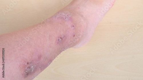 allergic reactions, itchy skin on leg, hives and other skin manifestations, Foot and Leg Conditions, skin problems on general physical and emotional well-being photo