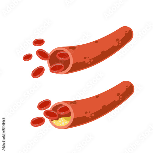 Cholesterol. Fat in arteries. Medical training scheme. Diseased and healthy vein. Disease of human blood system. Structure of blood vessels isolated on white background