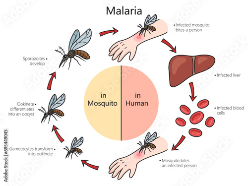 Malaria disease diagram hand drawn schematic vector illustration. Medical science educational illustration