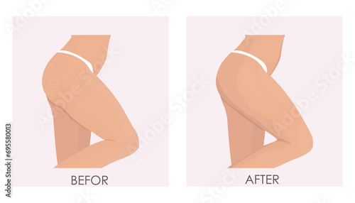 Vector illustration of treatment of stretch marks and stretch marks using cosmetic and laser techniques. Female buttocks before and after treatment. photo
