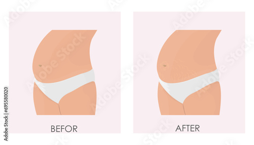 Vector illustration of treatment of stretch marks and stretch marks using cosmetic and laser techniques. The appearance of body imperfections during pregnancy. photo