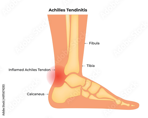 Achilles Tendinitis Science Design Vector Illustration photo