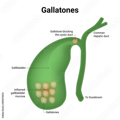 Gallstones Science Design Vector Illustration Diagram