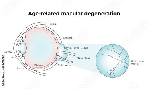 Age-Related Macular Degeneration Science Design Vector Illustration