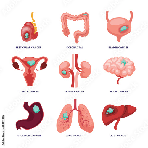 Set of different types of Common cancer types set collection, Testicular, Colorectal, Bladder, Uterus, Kidney, Brain, Stomach, Lung, Liver, malignant inflammation. Human organ tumor poster.
