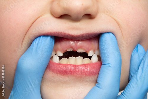 Losing primary teeth or milk teeth change. Close-up of fallen baby teeth on the upper jaw. Swelling of the gums. Dentist in blue medical gloves examines a child's oral cavity. Oral care concept photo