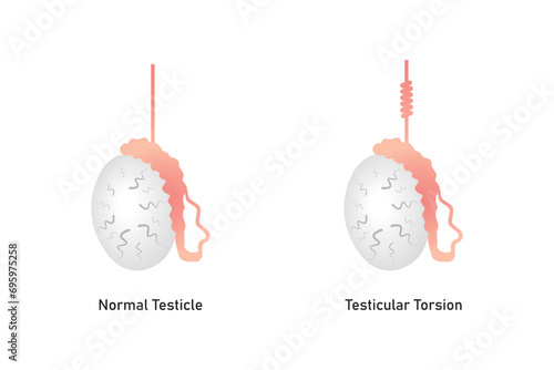 Testicular Torsion Disease Scientific Design. Vector Illustration.