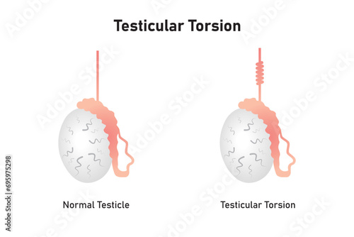 Testicular Torsion Disease Scientific Design. Vector Illustration.