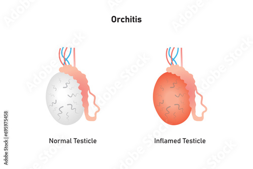 Orchitis Disease Scientific Design. Vector Illustration.