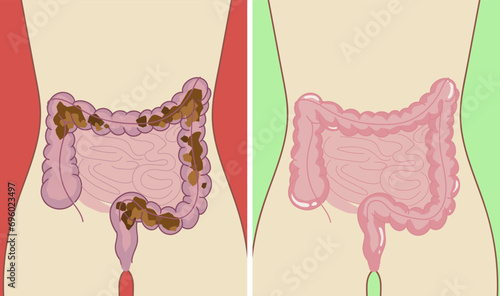 Intestinal obstruction, intestinal cleansing. Before after. Healthcare illustration. Vector illustration. 