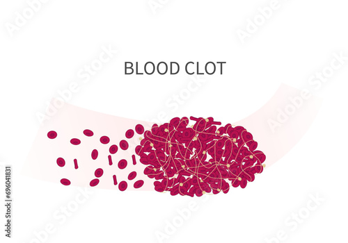 Erythrocytes and thrombus structure with platelets and fibrin at the background of blood vessel illustration for the main page of educational or medical material.