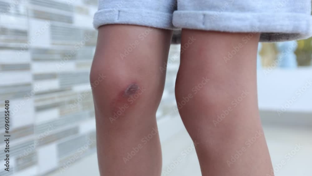 Unrecognizable boy in light shorts is scratching his healing knees, which were damaged. Insurance. Unrecognizable boy in light shorts is scratching his healing knees, which were damaged. Insurance.