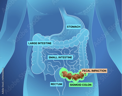 Bowel obstruction. Infographic. Healthcare illustration. Vector illustration. 