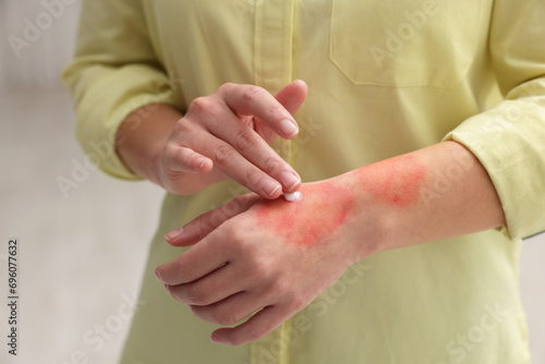 Woman applying healing cream onto burned hand indoors, closeup