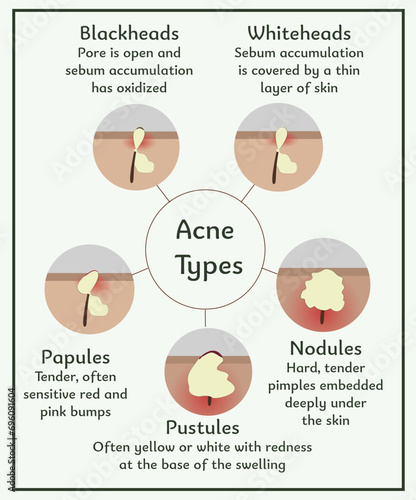 Acne types. Medical illustration. Infographic about skin and dermatology. An illustration for the study of inflammatory skin diseases. Treatment of acne. Stages of acne development. Detailed dermatolo