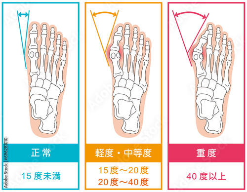 外反母趾　段階　足の骨　骨格図 photo