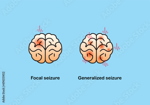 Illustration of seizure types demonstrating by onset and brain waves. photo