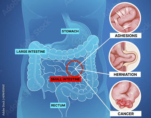 Bowel obstruction. Infographic. Healthcare illustration. Vector illustration.  photo