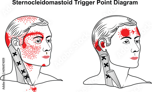 Sternocleidomastoid Trigger Point vector Diagram
