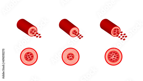 Arterial vasoconstriction and vasodilation. Cross section of arteries. Comparison of normal, constricted, and dilated blood vessels. Scientific Diagram. Vector illustration.