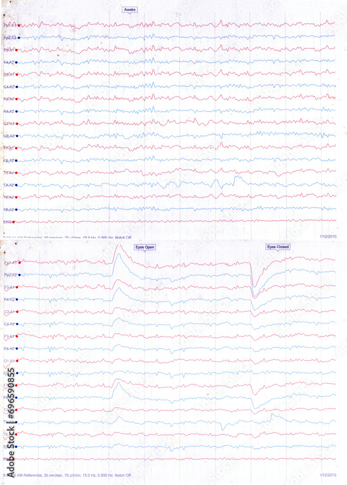 EEG Report, awake, eye open eye closed test, 56 years Male EEG Report, awake, eye open eye closed test, 56 years Male