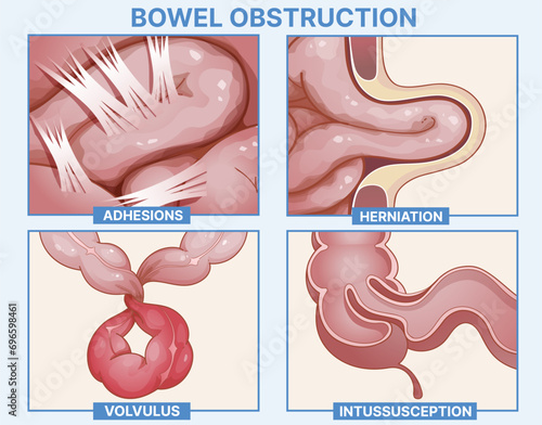Bowel obstruction. Infographic. Healthcare illustration. Vector illustration. 
