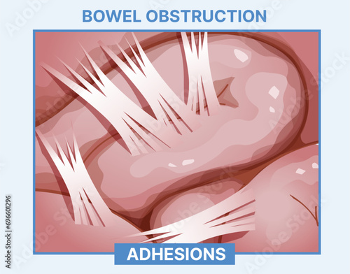 Bowel obstruction. Adhesions. Fibrous bands that form between tissues and organs. Infographic. Healthcare illustration. Vector illustration. 