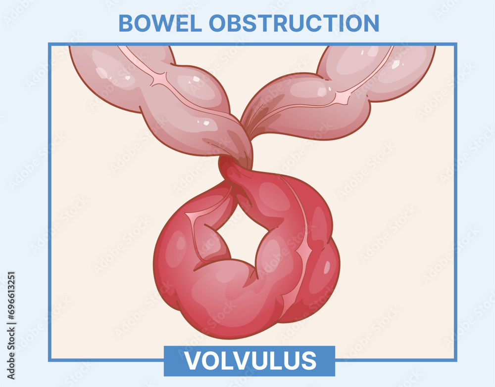 Volvulus Definition Bowel obstruction. Volvulus. Intestine twists around itself ...