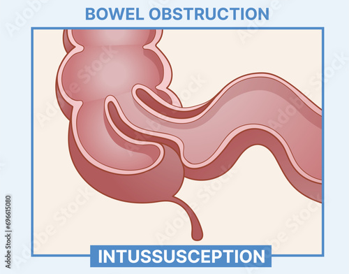 Bowel obstruction. Intussusception. Healthcare illustration. Vector illustration.  photo
