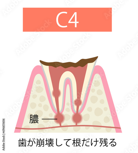 虫歯　C4 歯が崩壊し歯根だけ残る