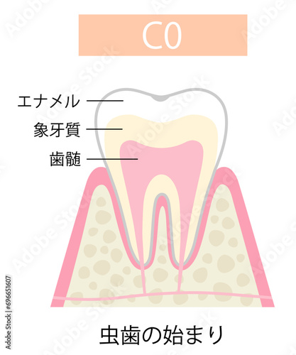 C0初期の虫歯
