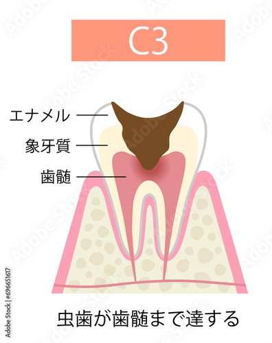 C3 虫歯が歯髄まで達する