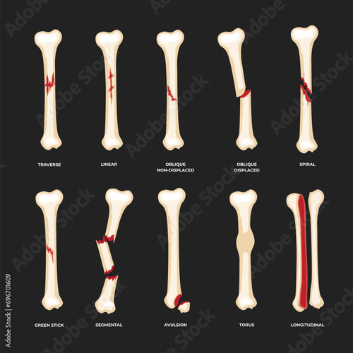 Fotografia Set of different types of bone fracture collection, Diagram of leg fracture in different stages for infographic biology education school, Femur Bones, human anatomy poster